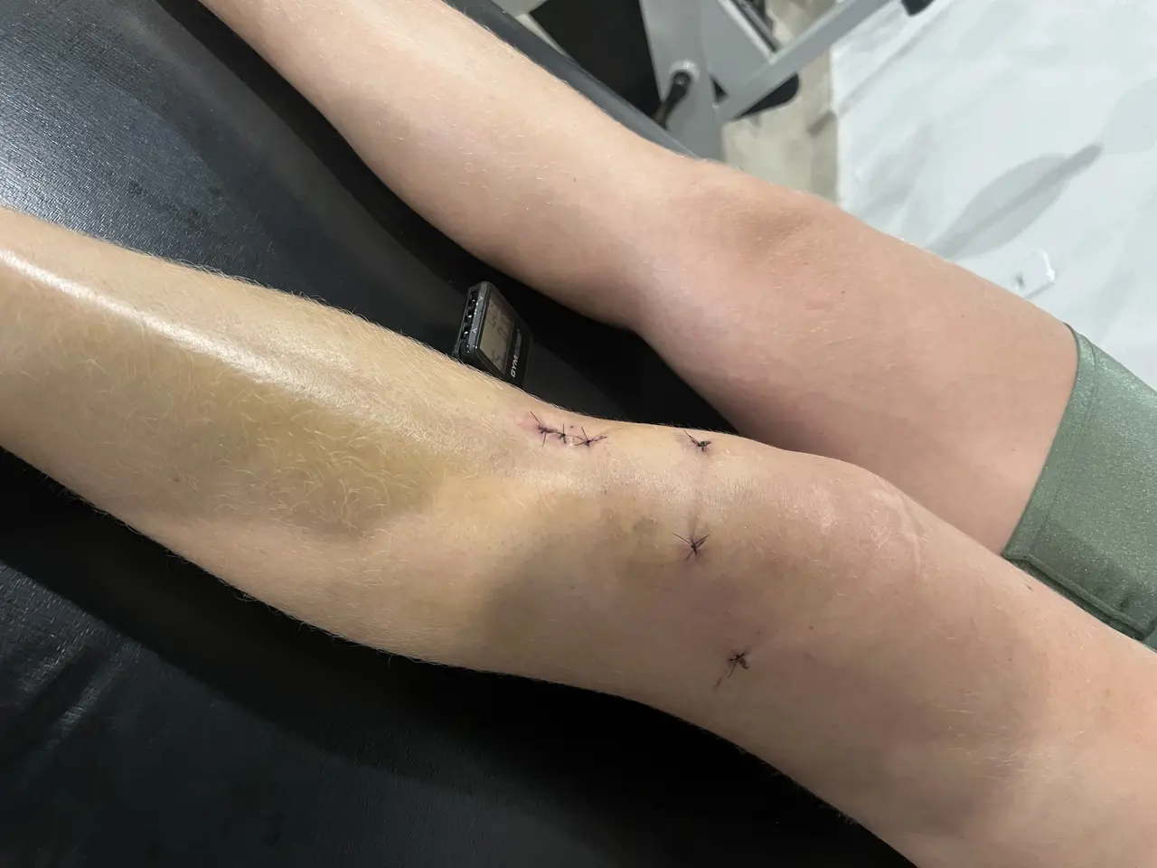 ABBA Fisioterapia - fisioterapia-pre-pos-operatorio